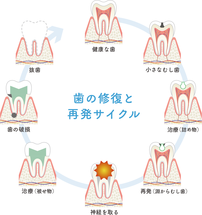 歯の修復と再発サイクル