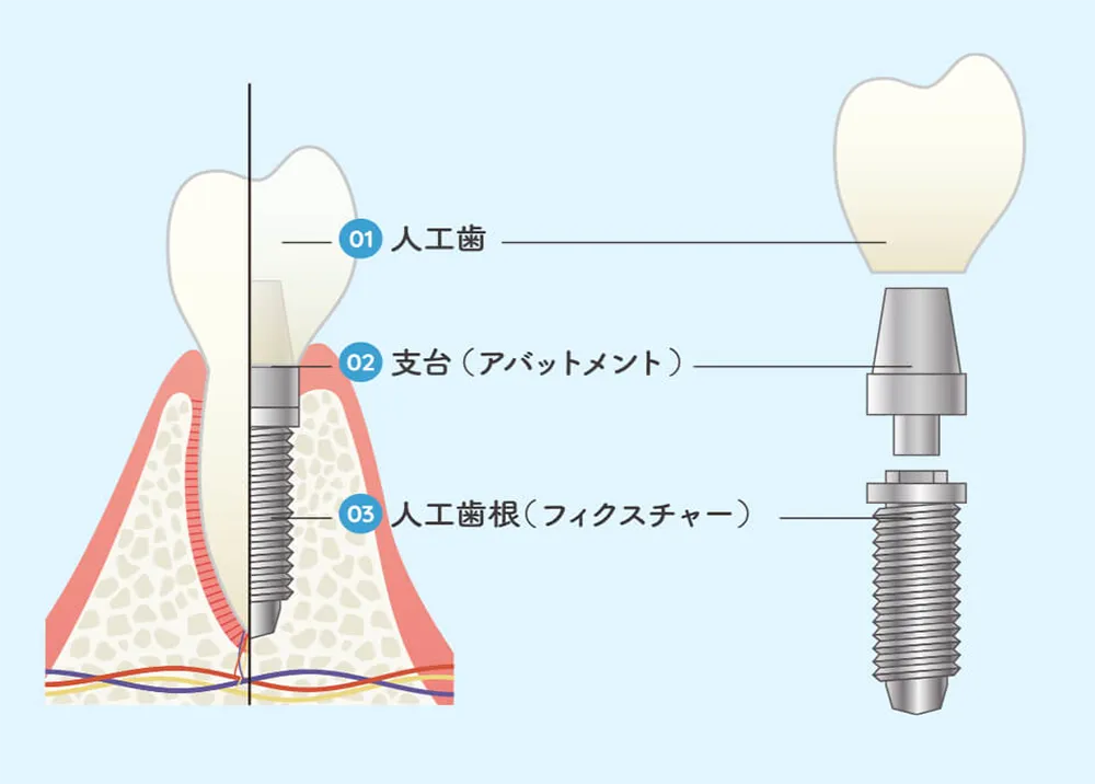 インプラントの構造を知るのイメージ