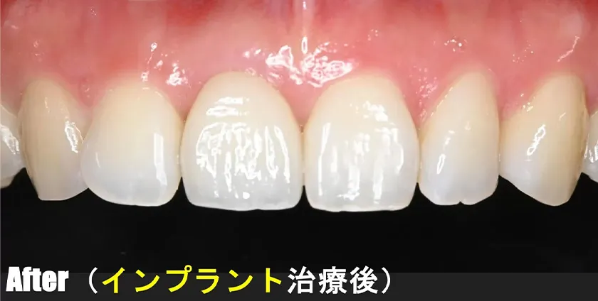 CASE01 治療後(インプラント治療後)