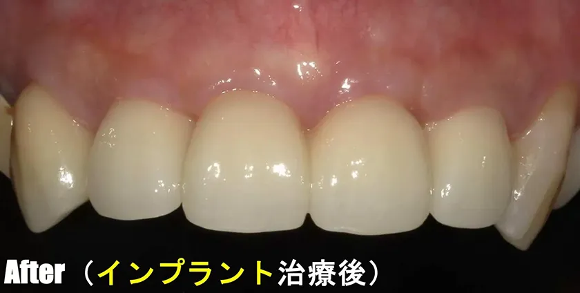 CASE02 治療後(インプラント治療後)
