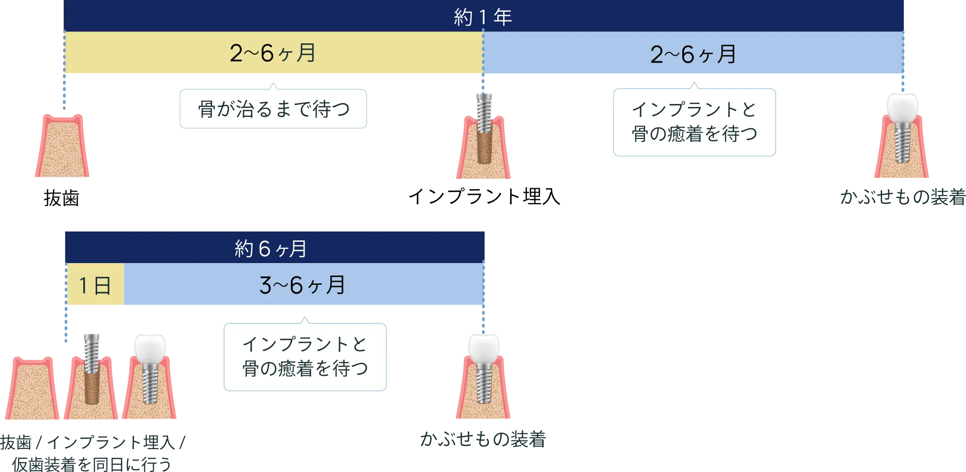 約一年かけて抜歯、インプラント挿入、被せもの装着を行っていたものが、約半年でそのすべてが完了する