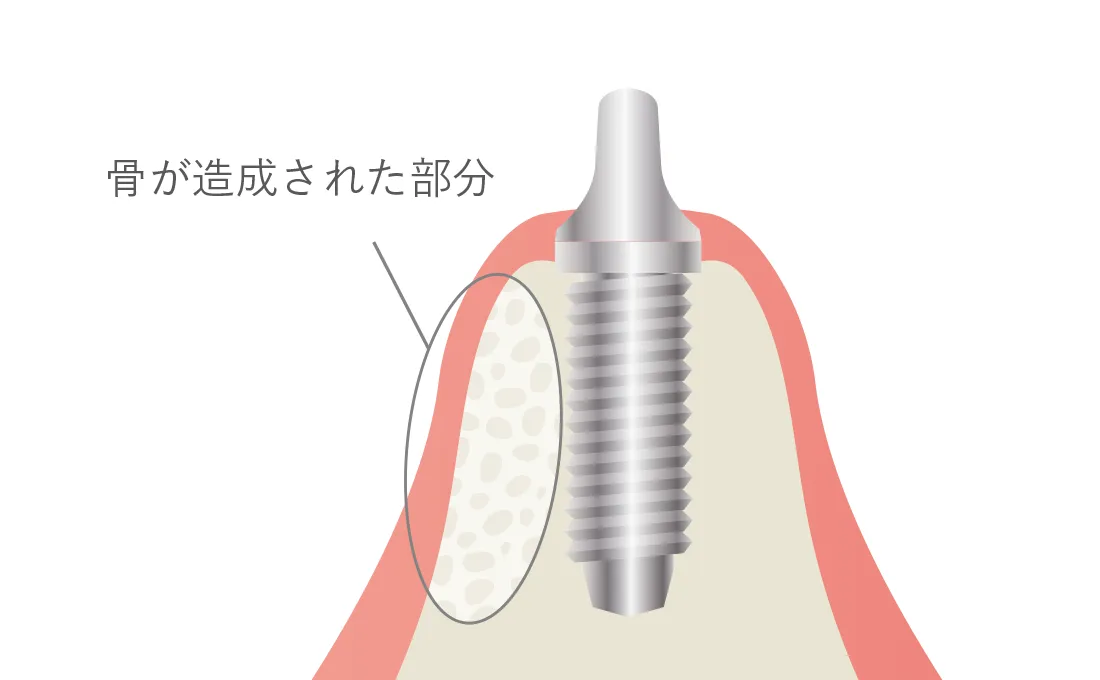 骨が造成された部分のイメージ