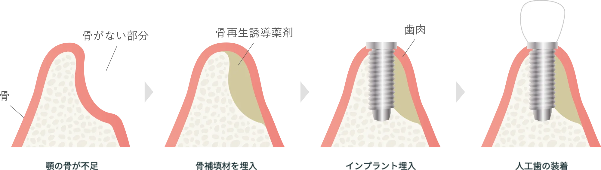 GBRの流れ:顎の骨が不足→骨補填材を埋入→インプラント埋入→人工歯の装着