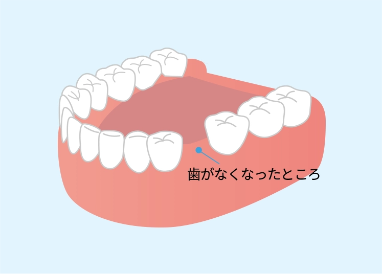 歯がなくなったところ