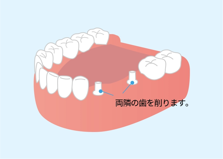 両端の歯を削ります