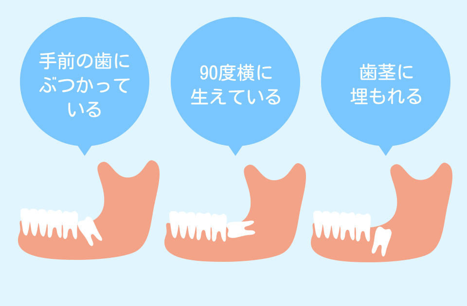 親知らずの抜歯