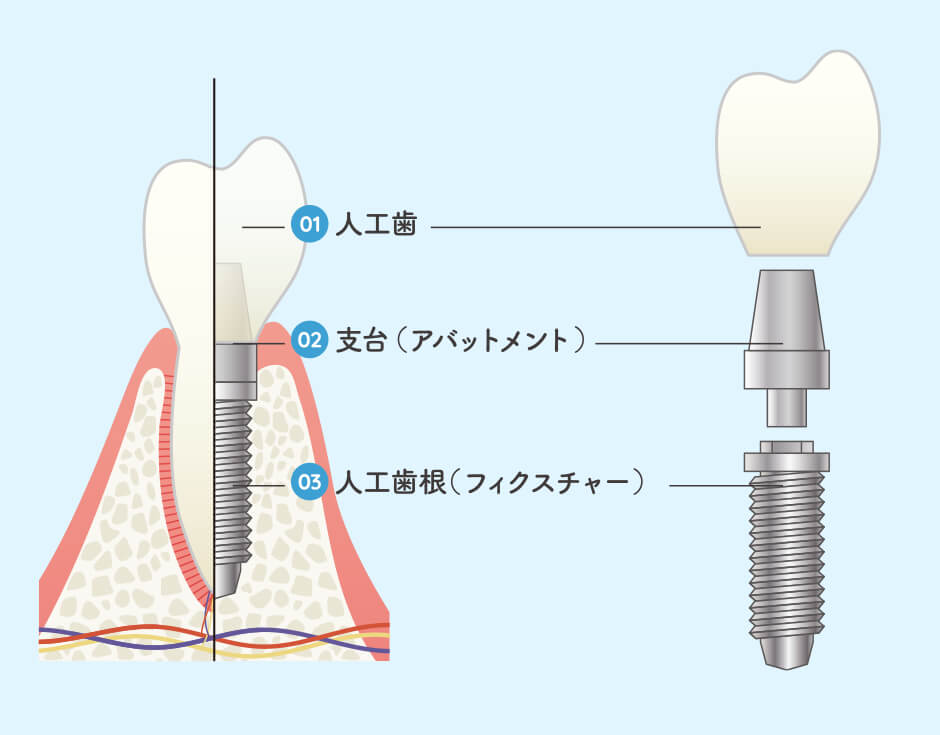 インプラント