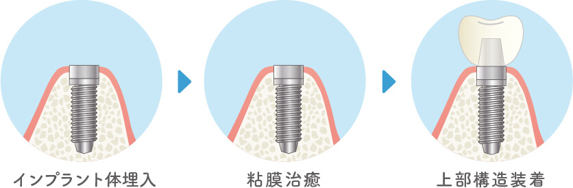 1回法
