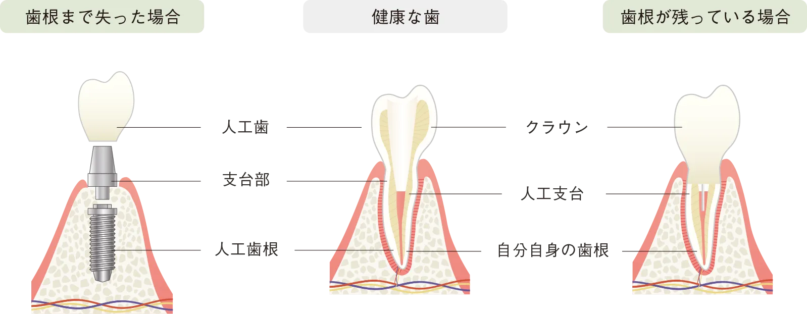 歯の構造と同等の構造で欠損歯を補い構築する