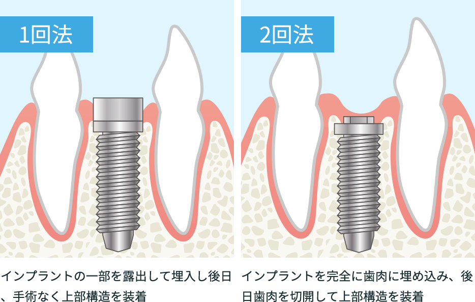 インプラントの手術方法