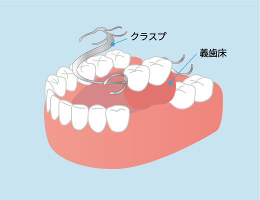 入れ歯