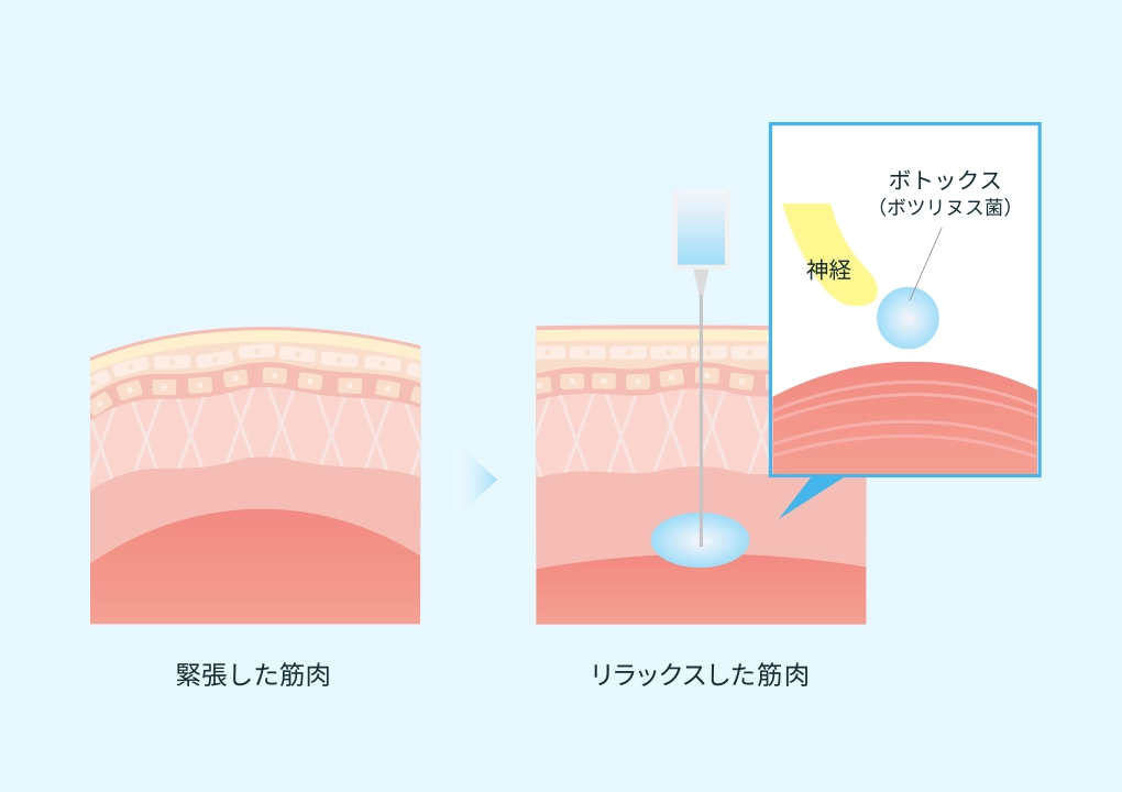 ボトックス注射