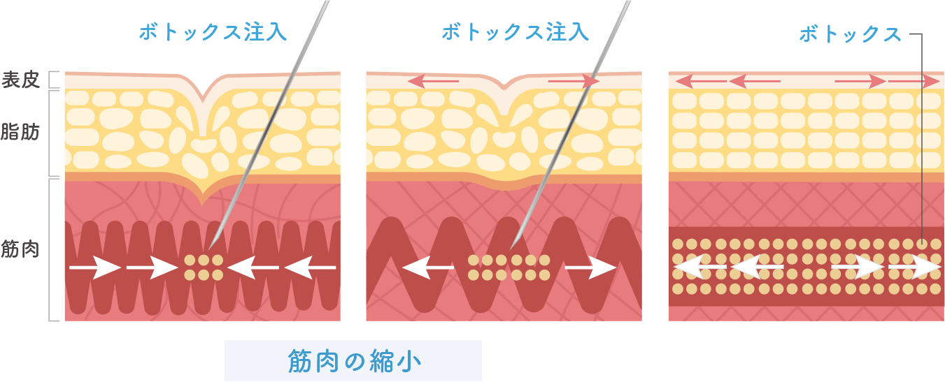 ボトックス治療のメカニズム