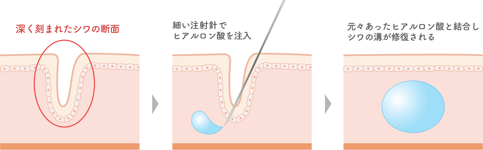 ヒアルロン酸注入のメカニズム