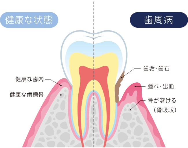 歯周病とは