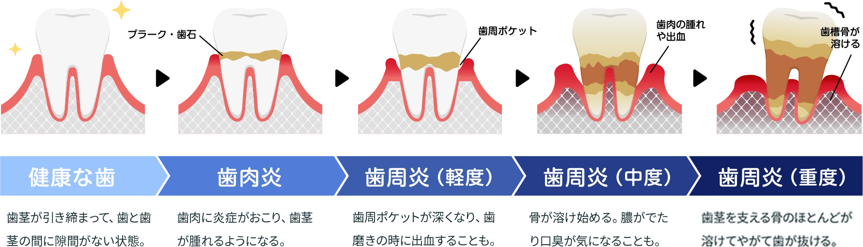 歯周病の進行ステージ