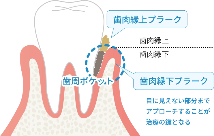 細菌をコントロール清潔な口腔環境をつくる