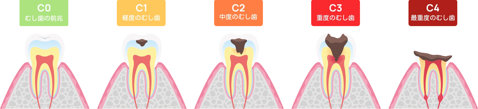 むし歯の進行ステージ