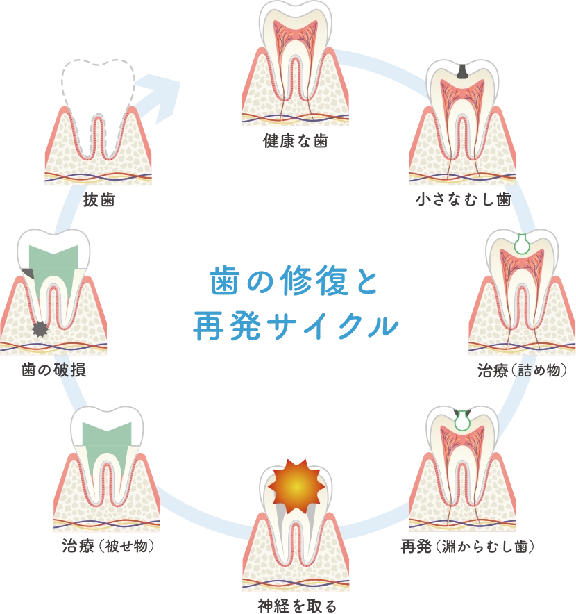 むし歯治療の考え方