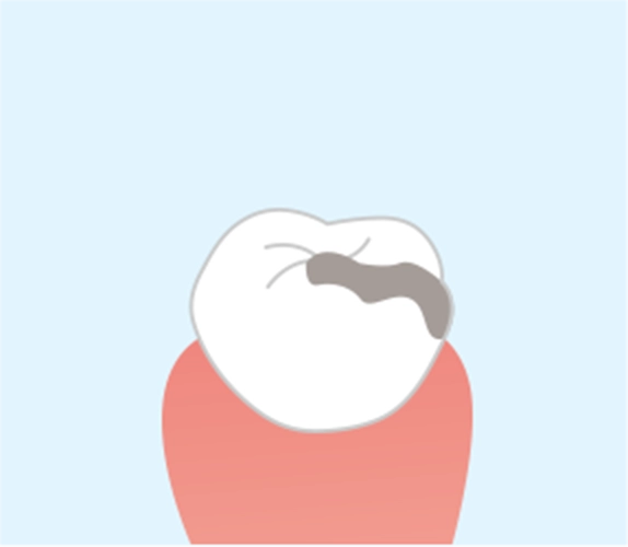 むし歯を削り成形
