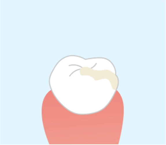 研磨し歯のかたちを整える