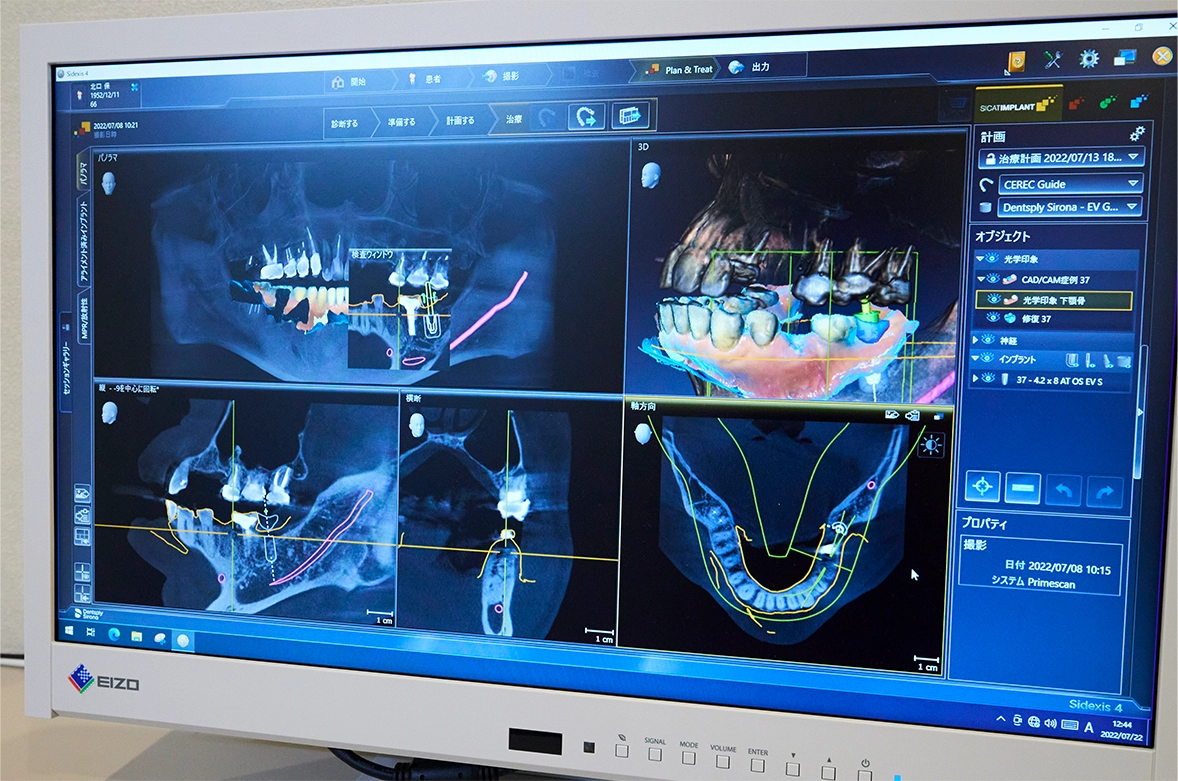 CTによる3D画像診断